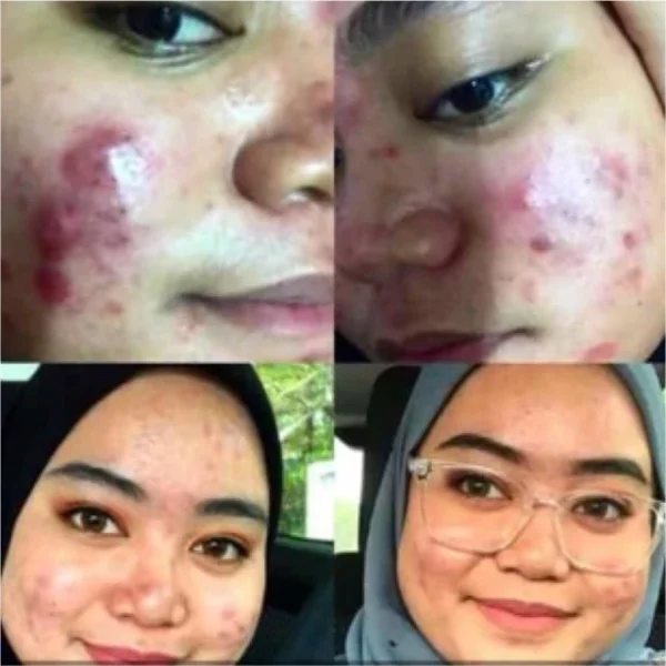 🎁 ALHA ALFA SERUM SKIN BOOSTER 100% ORI HQ (MERAWAT SKIN YG BERMASALAH , BERJERAWAT Alha Alfa Royal Propolis - Image 5